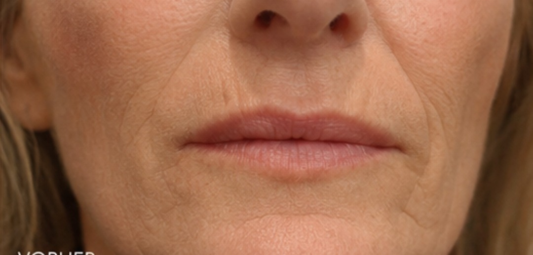 Lippenpartie vor der Behandlung mit feinen Plisseefältchen