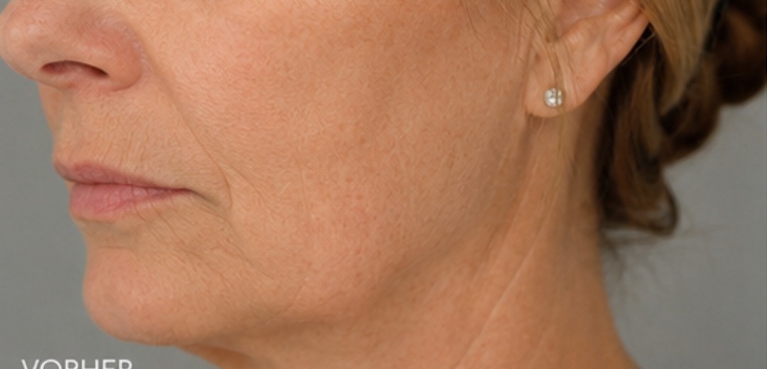 Kinn- und Jawline-Profil vor der Behandlung