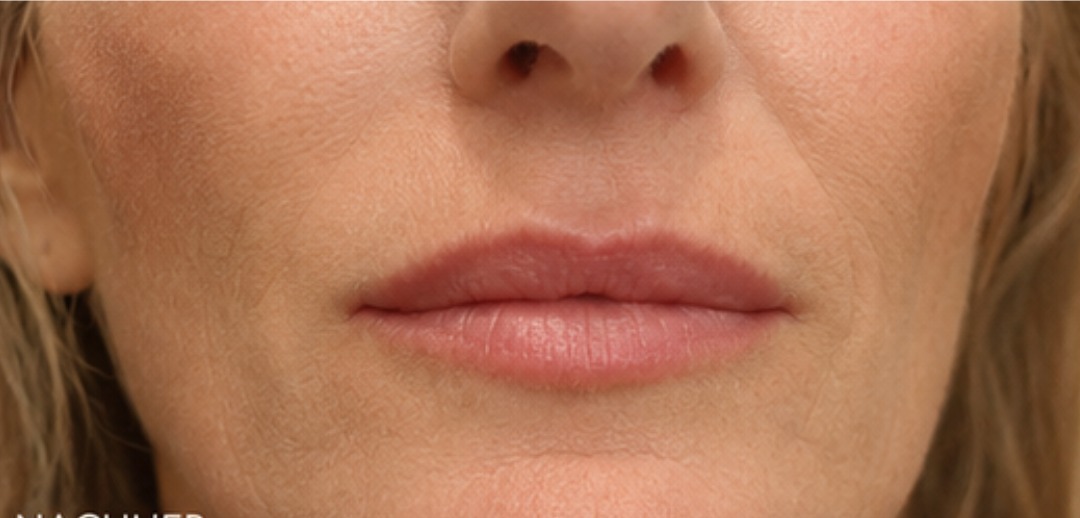 Lippenpartie nach der Behandlung mit dezent definierter Kontur